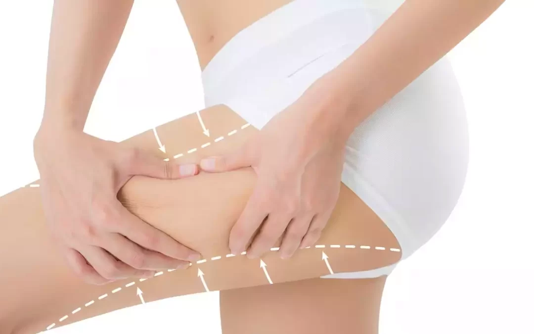 Thigh Liposuction